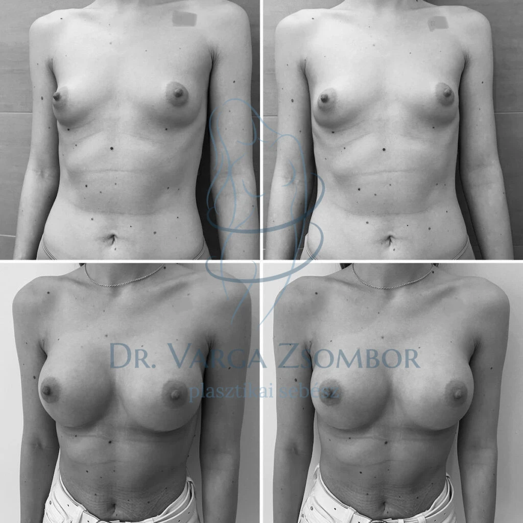 23 éves hölgy páciensünk előtte-utána képei 