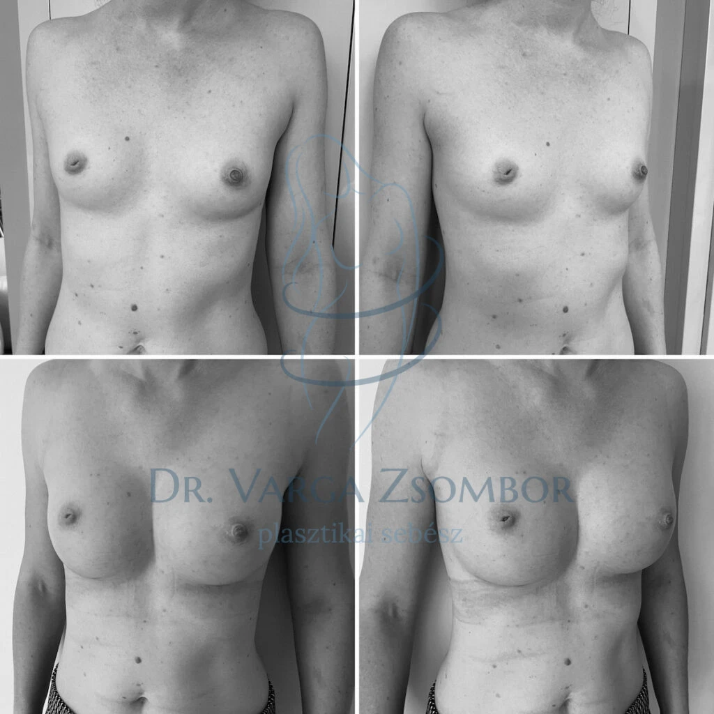 275 köbcentis mellimplantátum (előtte-utána képpel)