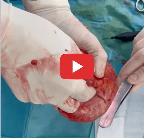 Texturált felszínű implantátum eltávolítása tokkal együtt (műtéti videó)