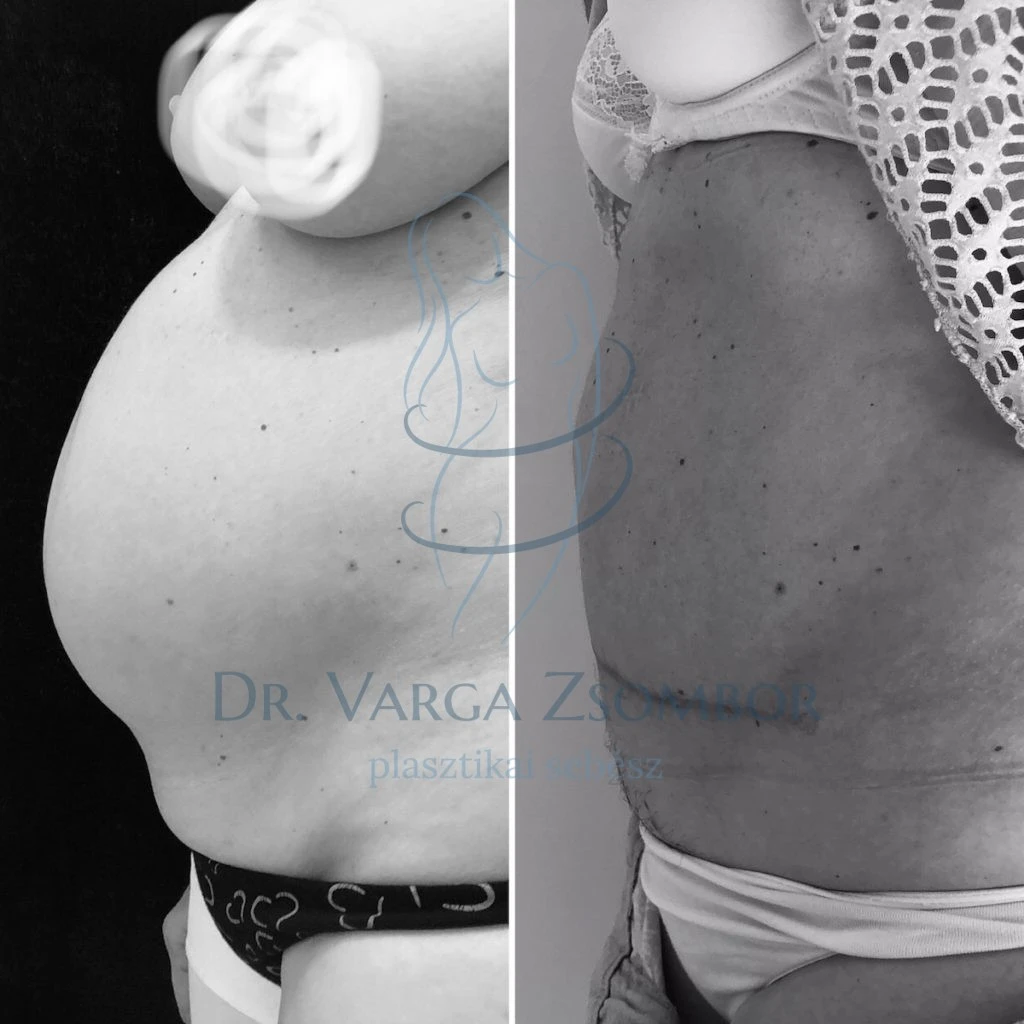 A szétnyílt hasizom (rectus diastasis) - előtte utána képpel