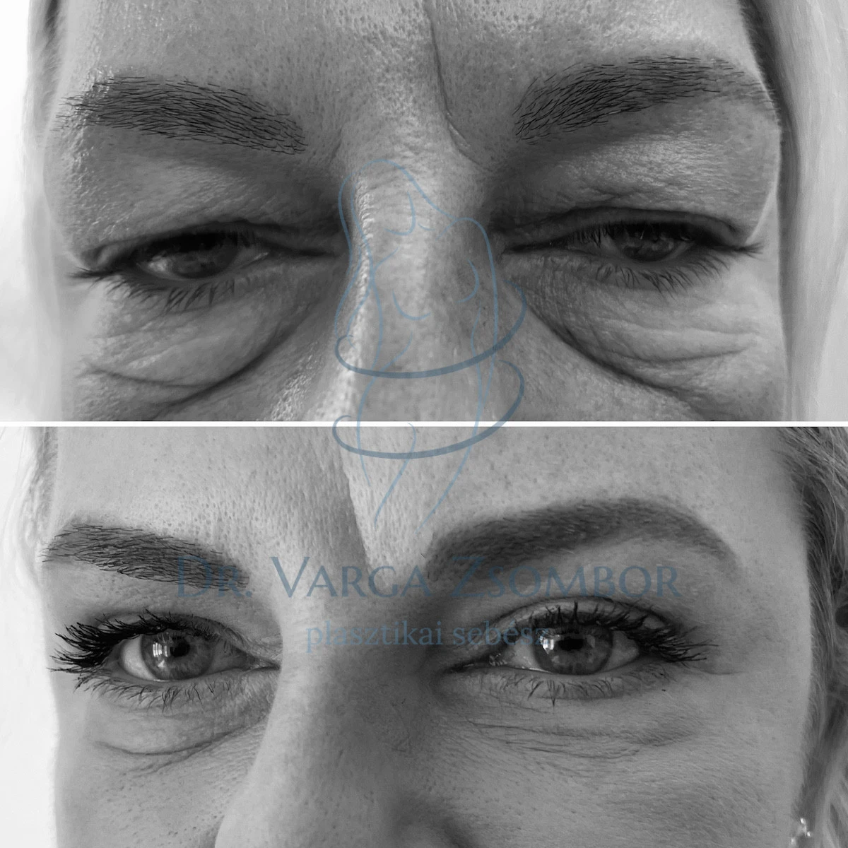 Alsó és felső szemhéjplasztika