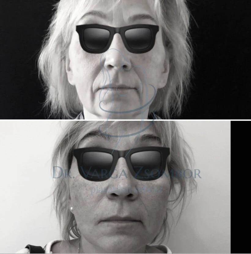 Arcplasztika - amikor a szike a legjobb döntés