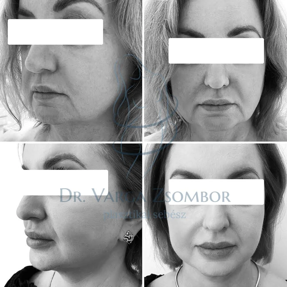 Arcplasztika: mikor érdemes? (előtte-utána képpel)