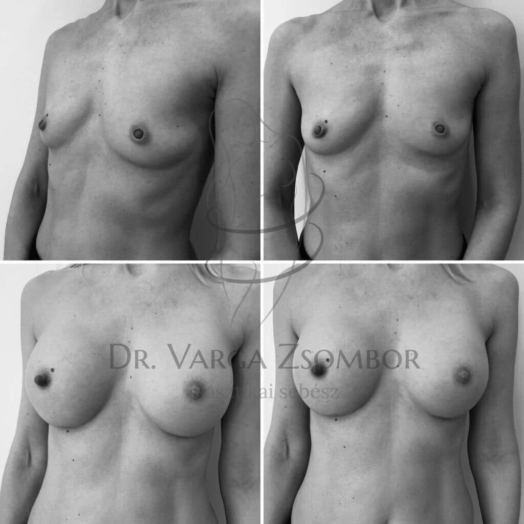 Az ötven az új harminc (mellnagyobbítás előtte-utána kép)