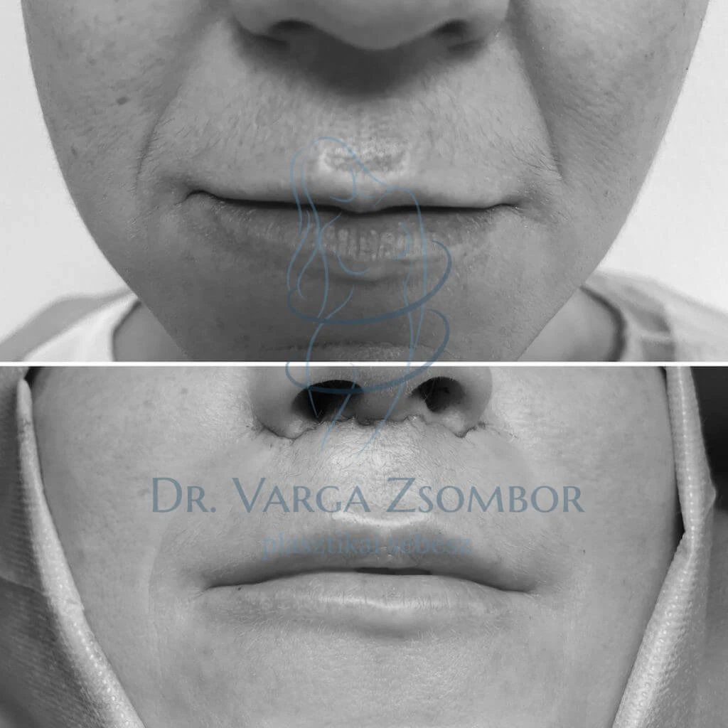 Diszkrét lip lift (ajakemelés)