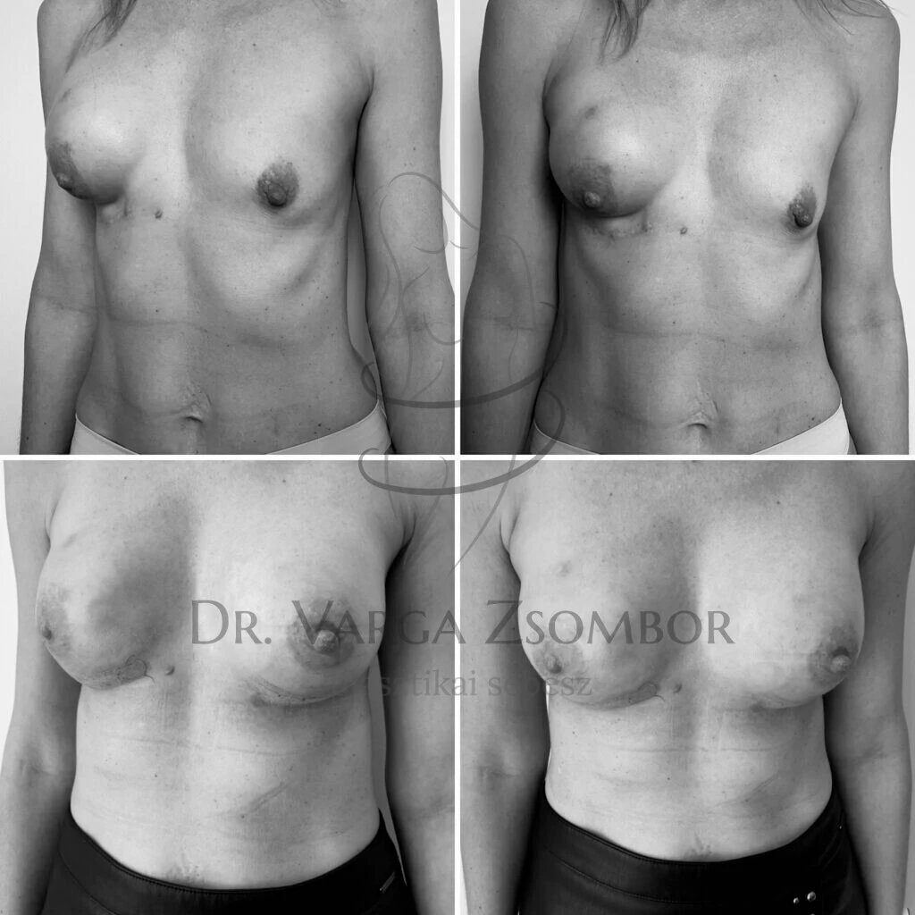 Emlőhelyreállítás (mellrekonstrukció) két lépésben
