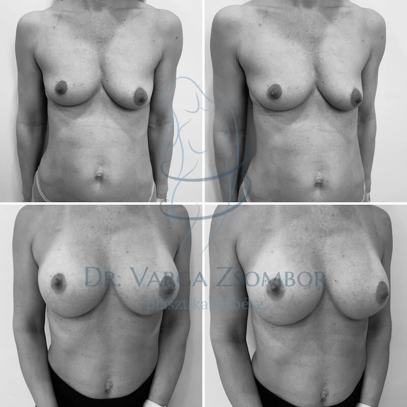 Enyhe fokú emlőaszimmetria korrekciója különböző méretű implantátumokkal
