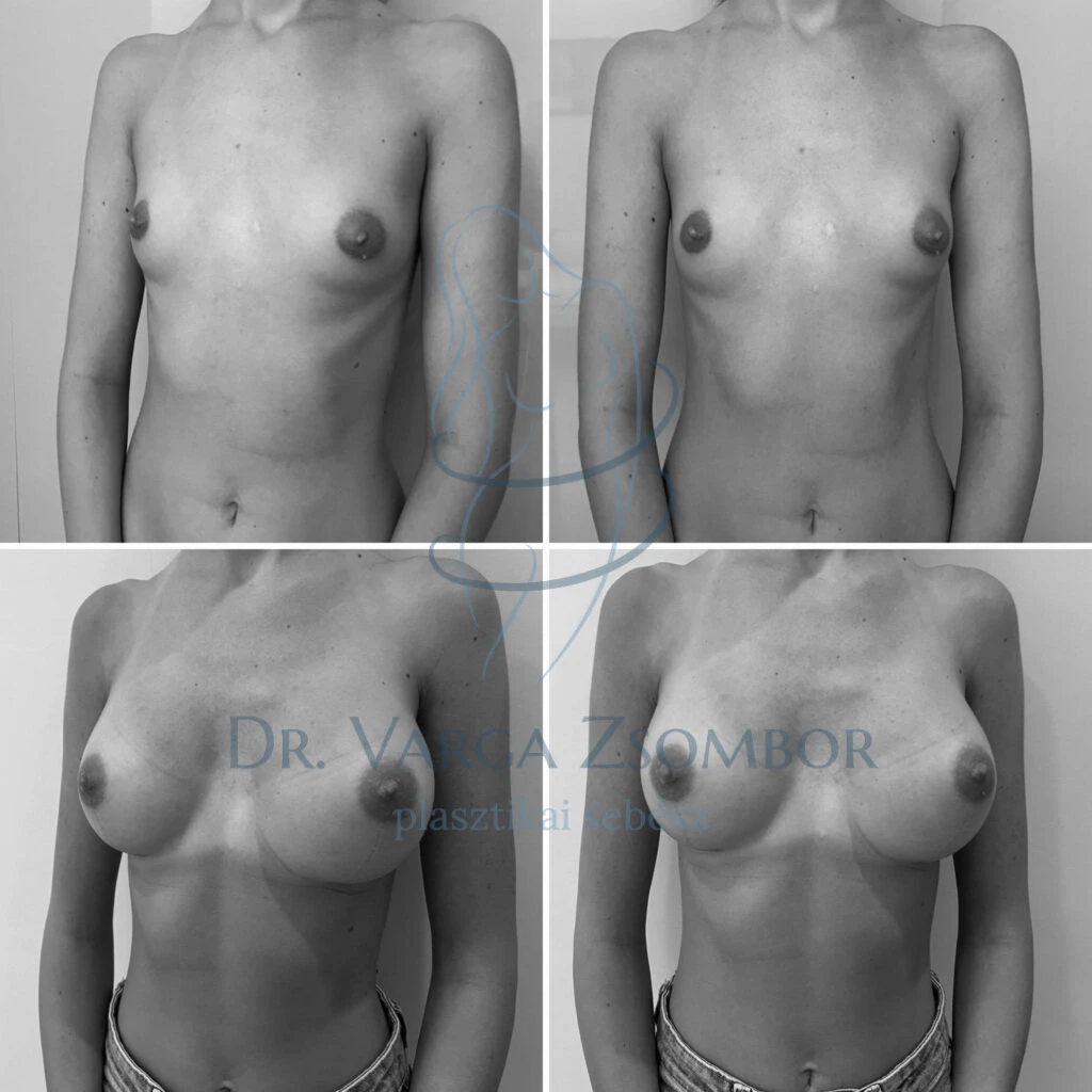 Enyhe mell aszimmetria megoldása