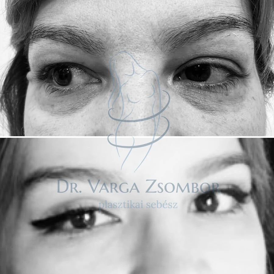 Felső szemhéjplasztika (előtte-utána képpel)