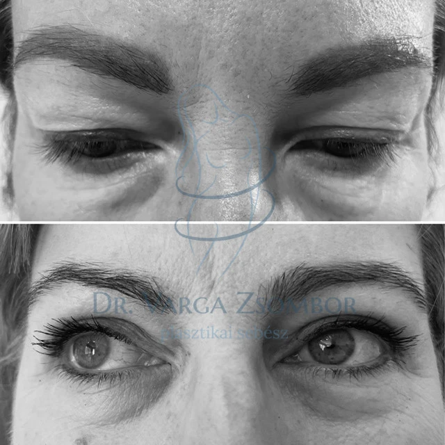 Felső szemhéjplasztika előtte-utána kép
