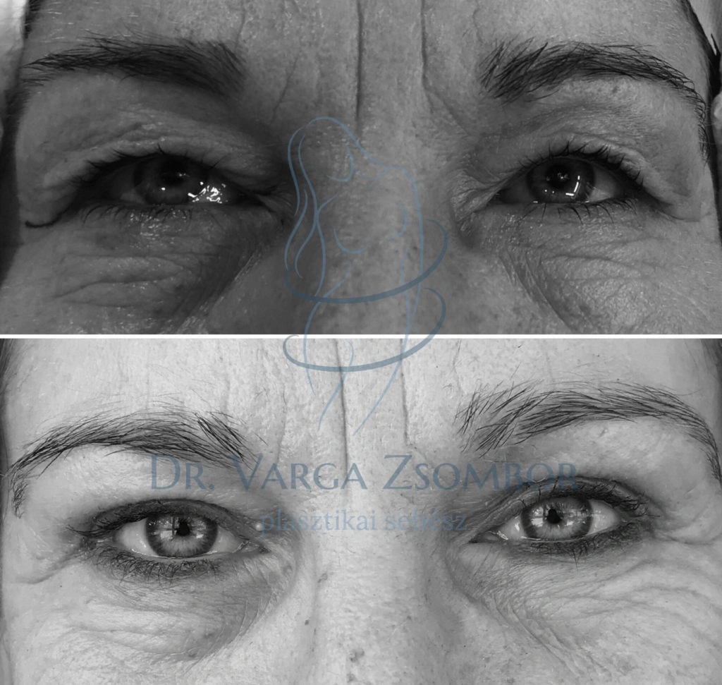 Felső szemhéjplasztika előtte-utána képek