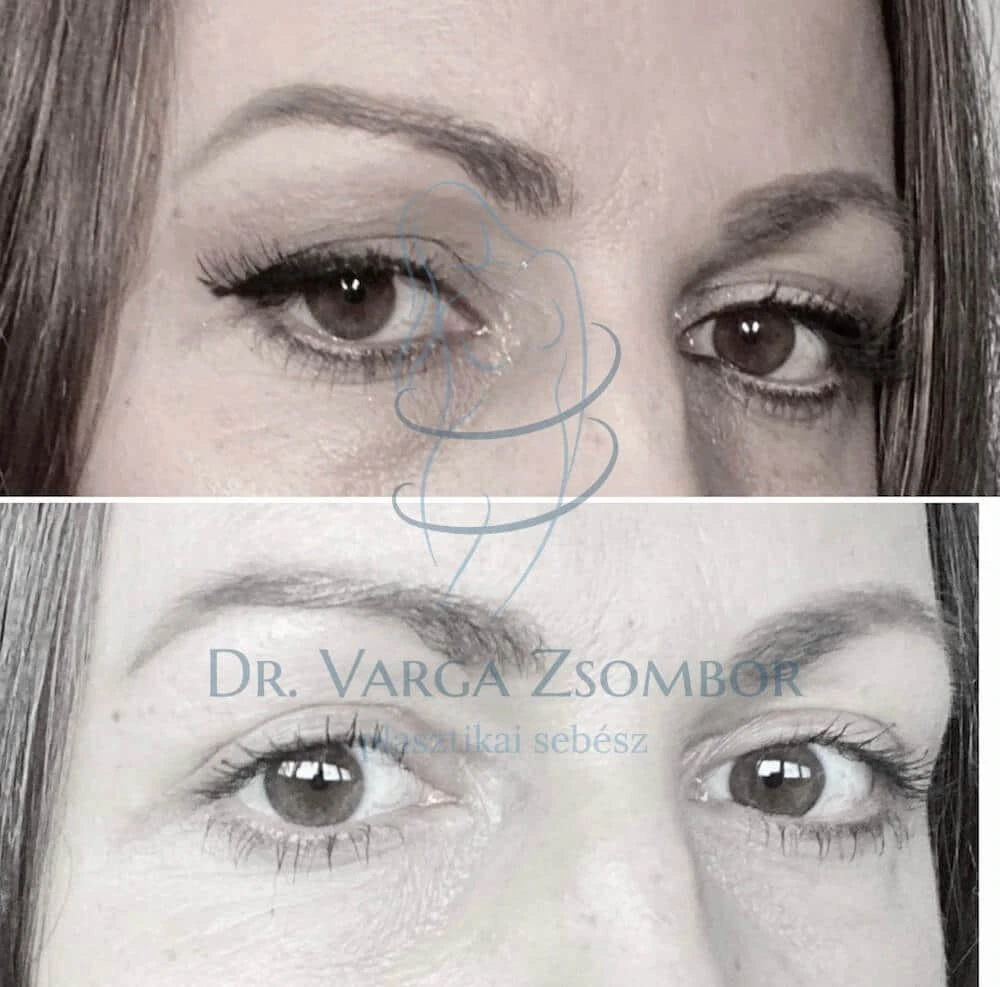 Felső szemhéjplasztika vagy smink