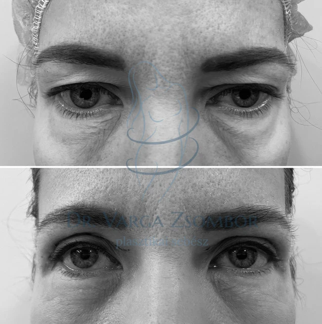 Felső szemhéjplasztika