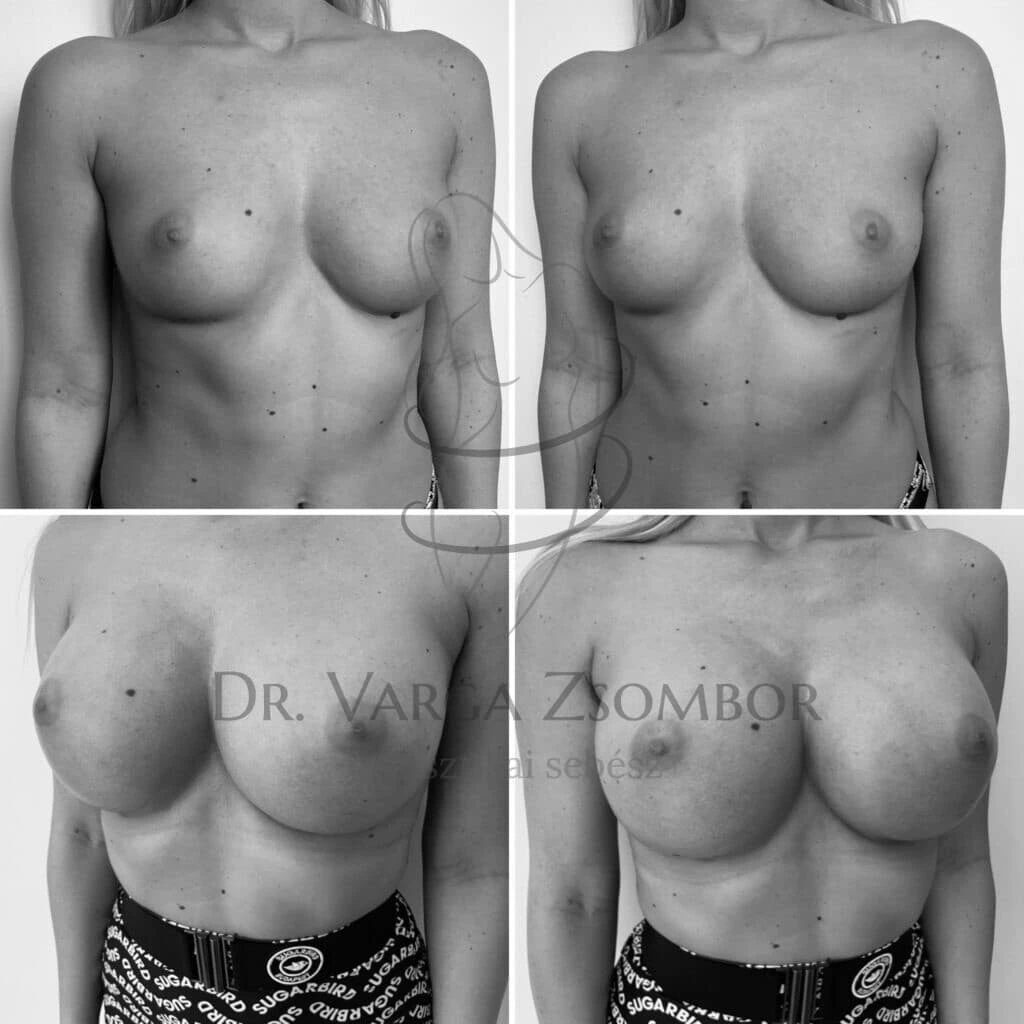 Fibroadenoma eltávolítása és implantátummal való korrekció