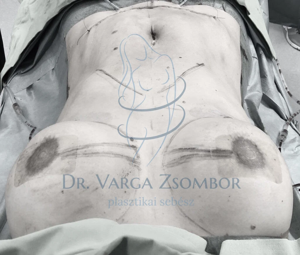 Has + mellplasztika, műtétes kép az altatóorvos szemszögéből