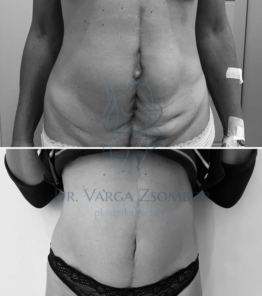 Hasfali helyreállítás nőgyógyászati műtét után