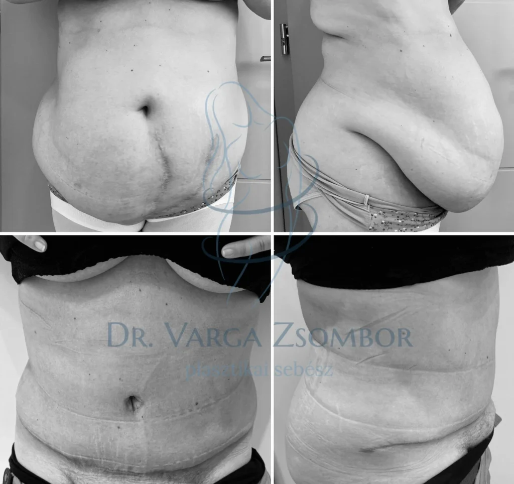 Csodatévő hasplasztika