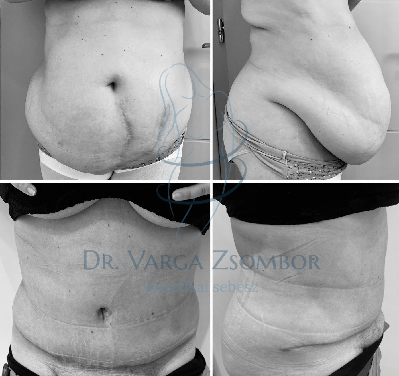 Csodatévő hasplasztika