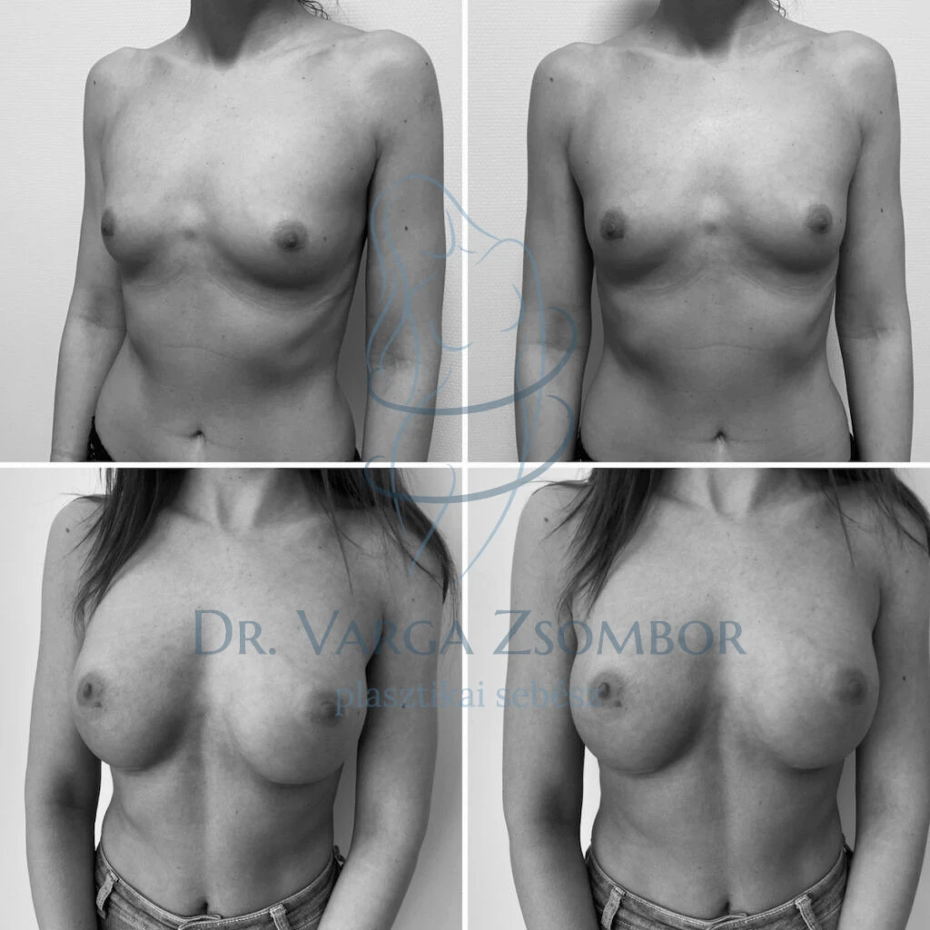 Kerek, 250cc mellimplantátum