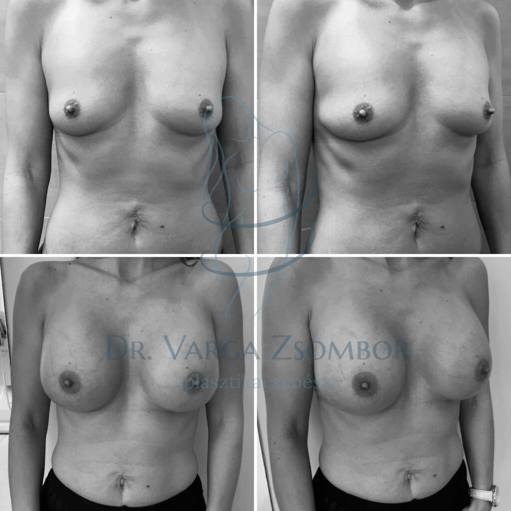Köldöksérv megoldása és mellkorrekció implantátummal