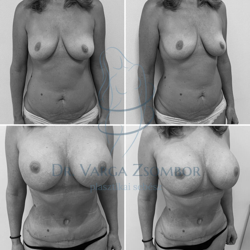 Kombinált has+mellplasztika (mommy makeover)