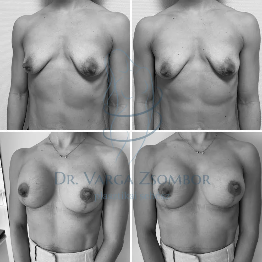 Kombinált mellplasztika előtte-utána fotó