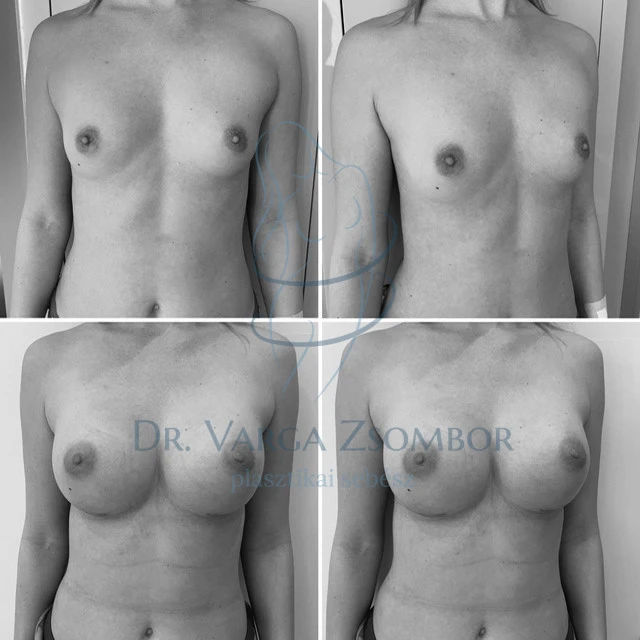 Mell aszimmetria plasztika ( előtte-utána képpel)