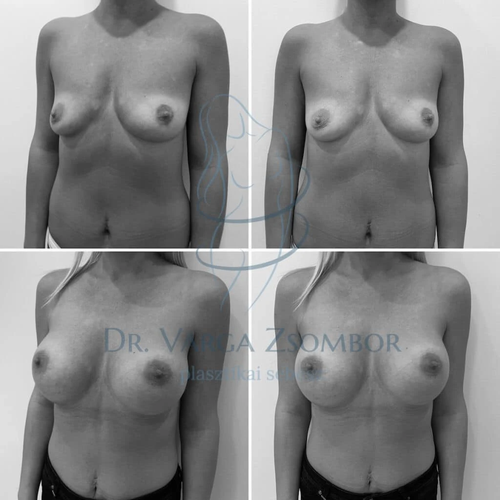 Mell aszimmetria korrekciója különböző méretű implantátumokkal
