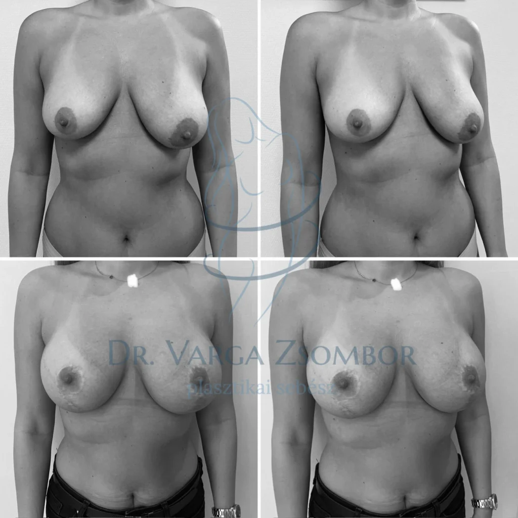 Mellfelvarrás és 325cc implantátum behelyezés (előtte-utána fotó)