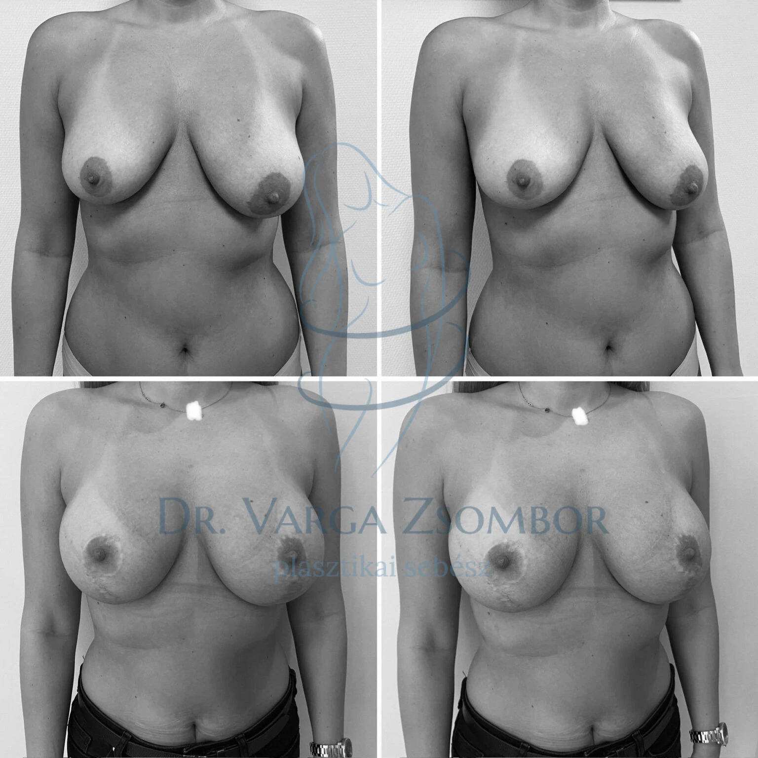 Mellfelvarrás és 325cc implantátum behelyezés (előtte-utána fotó)