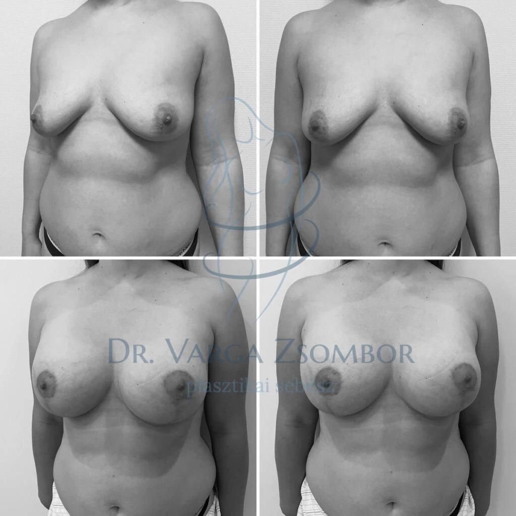 Mellfelvarrás implantátummal kombinálva