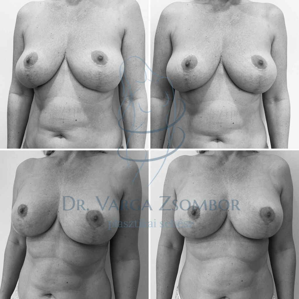 Mellfelvarrás korábbi mellkisebbítő műtét után