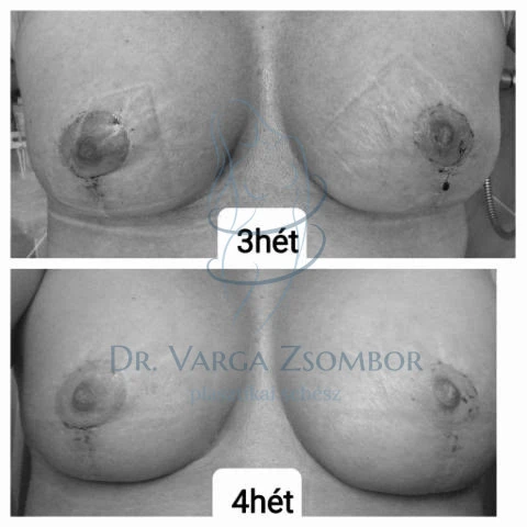 Mellfelvarrás műtét után