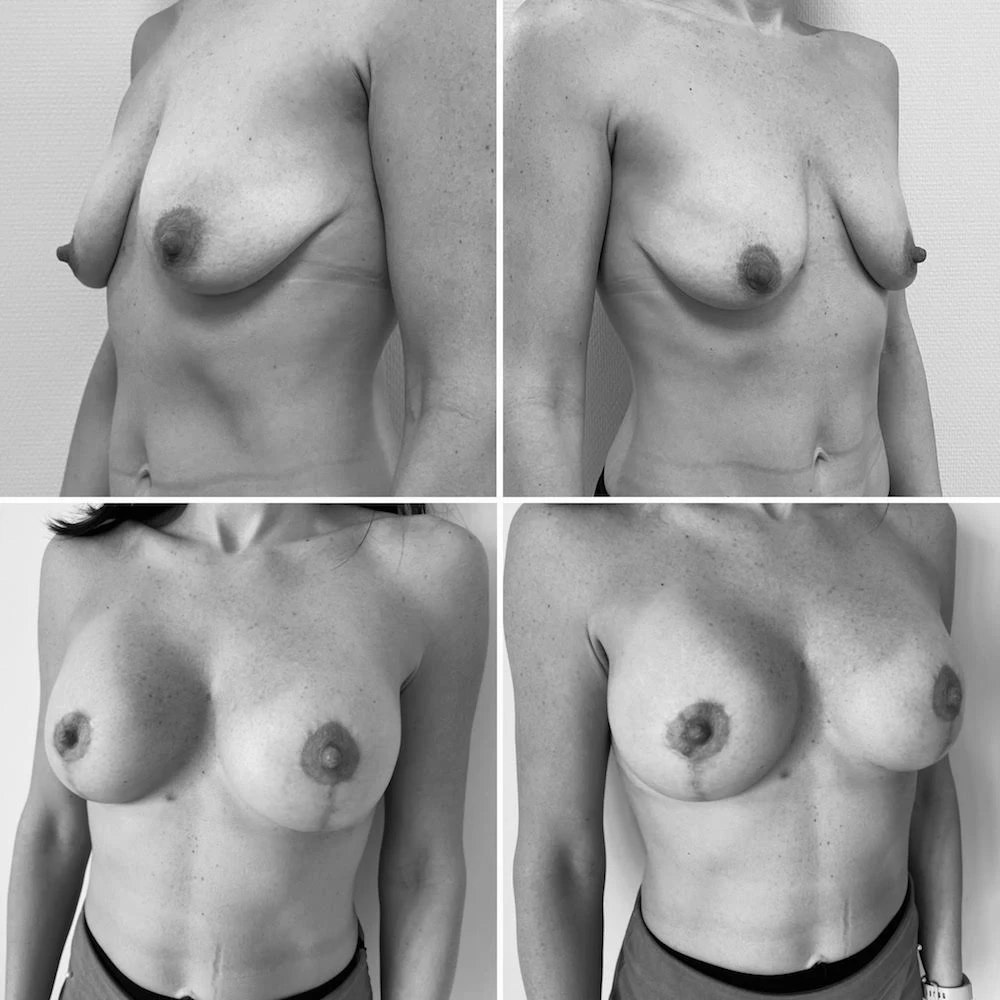 Mellimplantátum felvarrással kombinálva