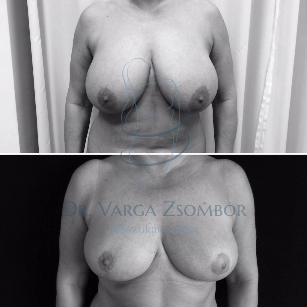 Mellkisebbítés, avagy ha túl nagy a cici...