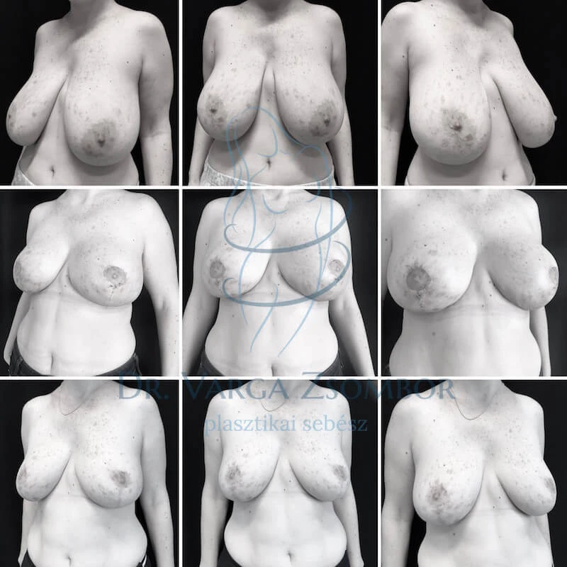 Mellkisebbítés után 3 héttel, 6 hónappal