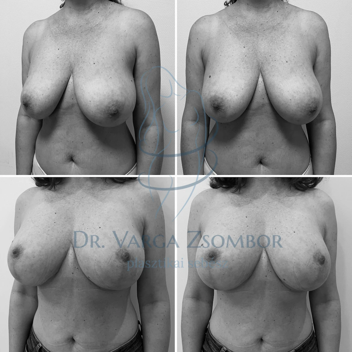 Egy mellkisebbítő műtét elő- és utóélete