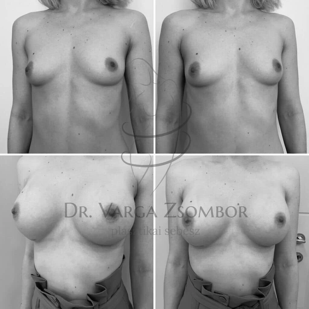 Mellnagyobbítás implantátummal