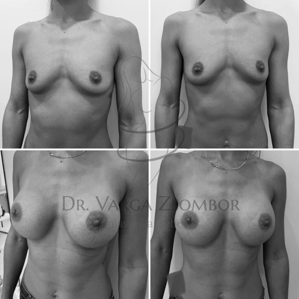 Mellnagyobbítás kerek implantátummal (előtte-utána fotó)