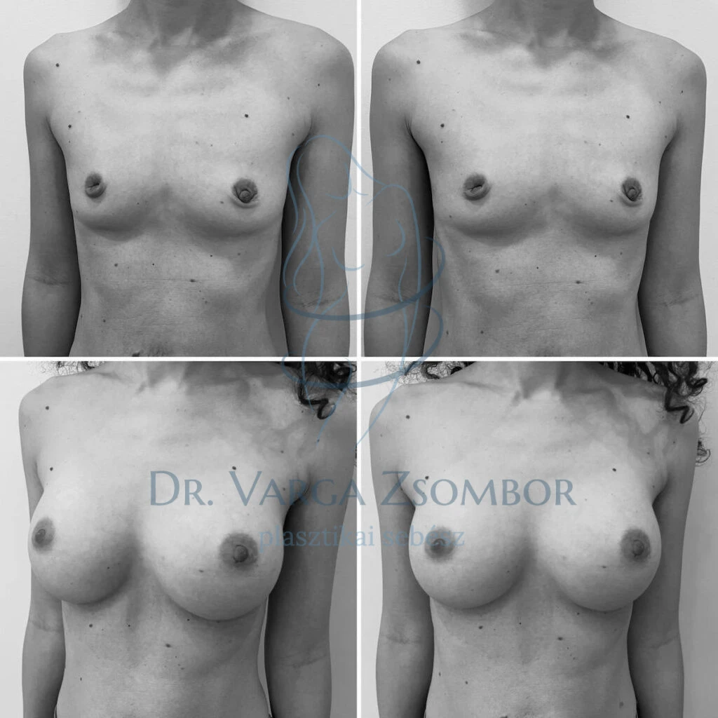 Mellplasztika (előtte-utána képek)