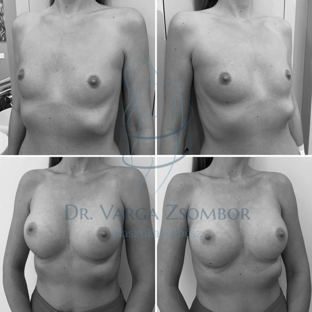 Mellplasztika középmagas implantátumokkal