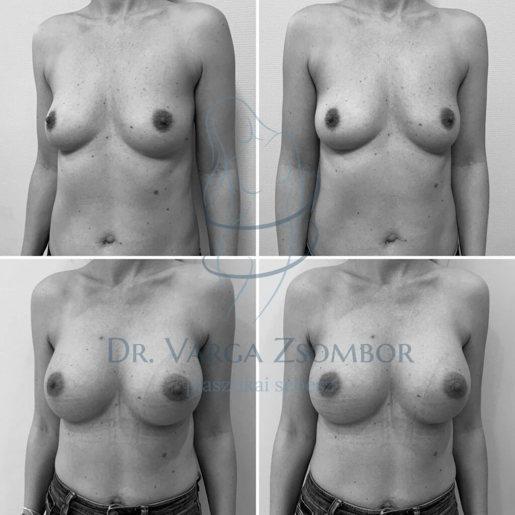 Mellplasztika szülés és szoptatás után