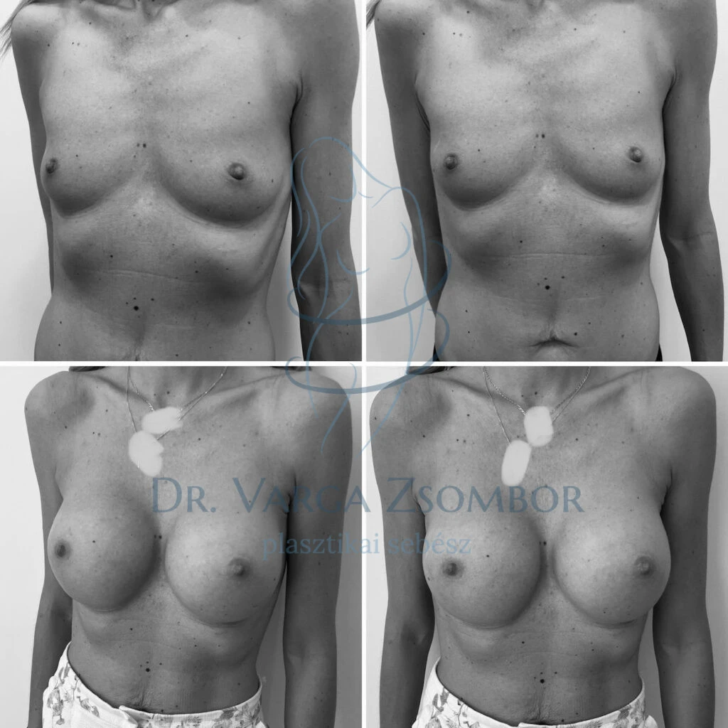 Mellplasztika után
