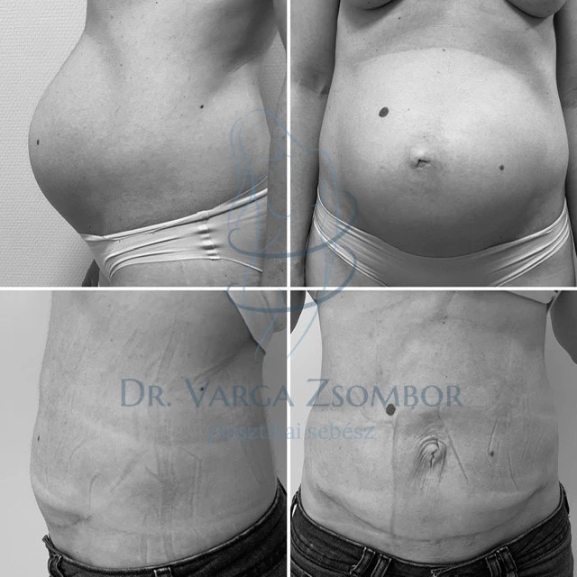 Midi hasplasztika (szétnyílt hasizom+köldöksérv)