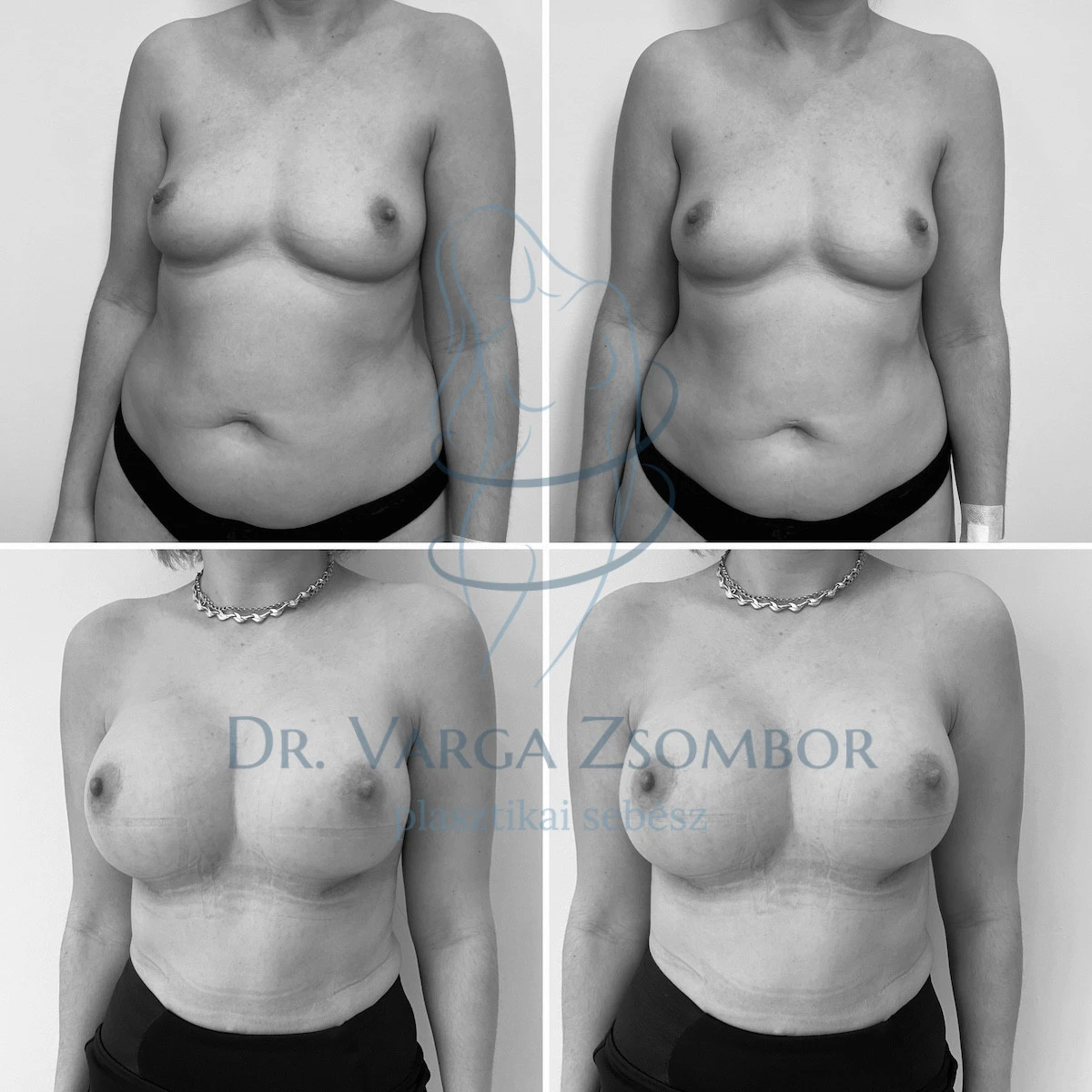 Mommy makeover megint megbabonáz