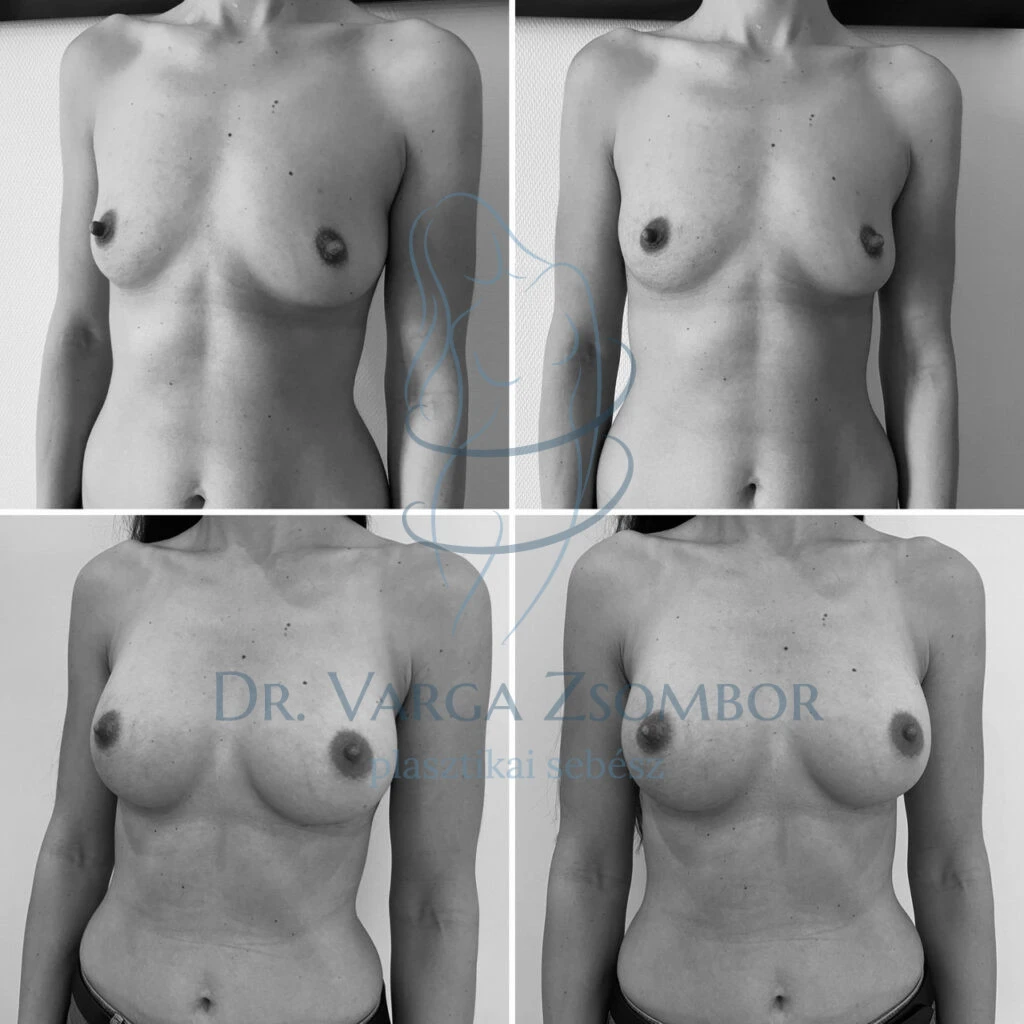 Sportos alkatnál is lehet természetes hatású a mellplasztika