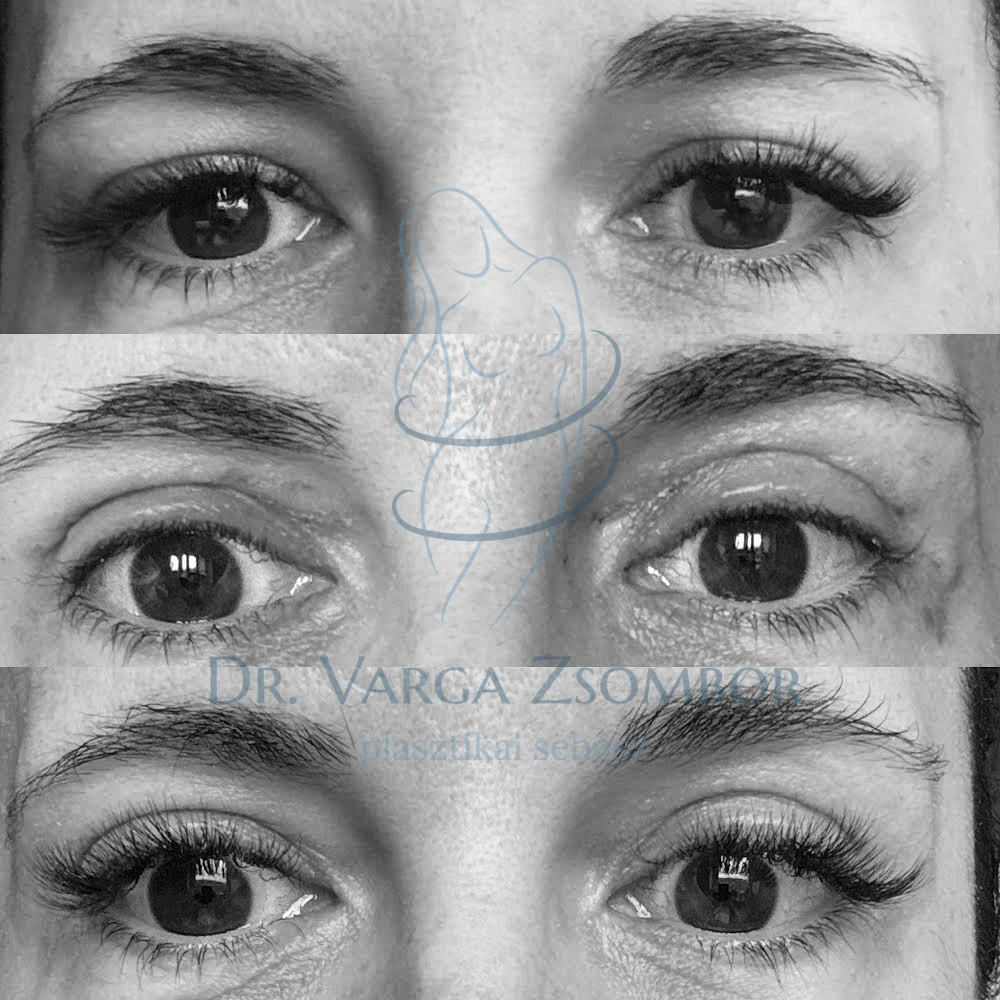 Szemhéjplasztika előtte-utána