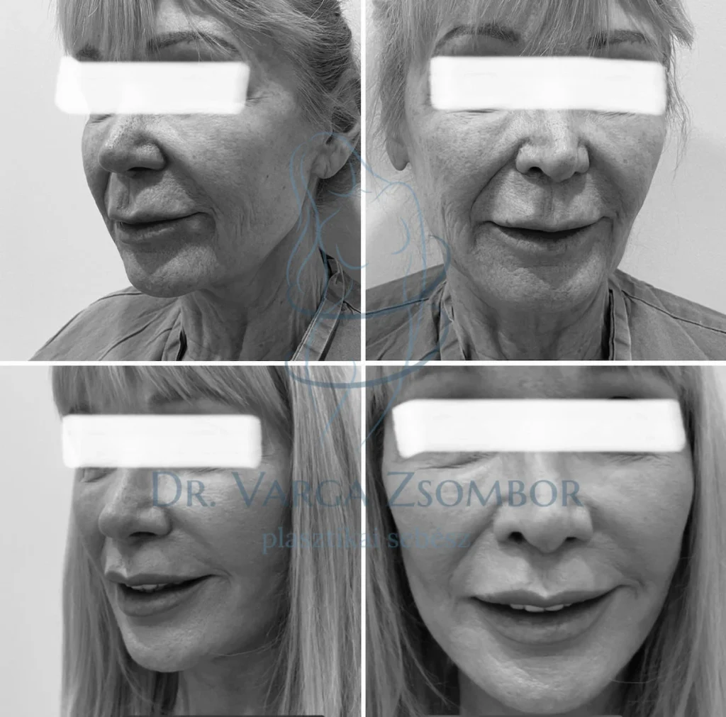 Teljes arc- és nyakplasztika műtét ajakemeléssel kiegészítve