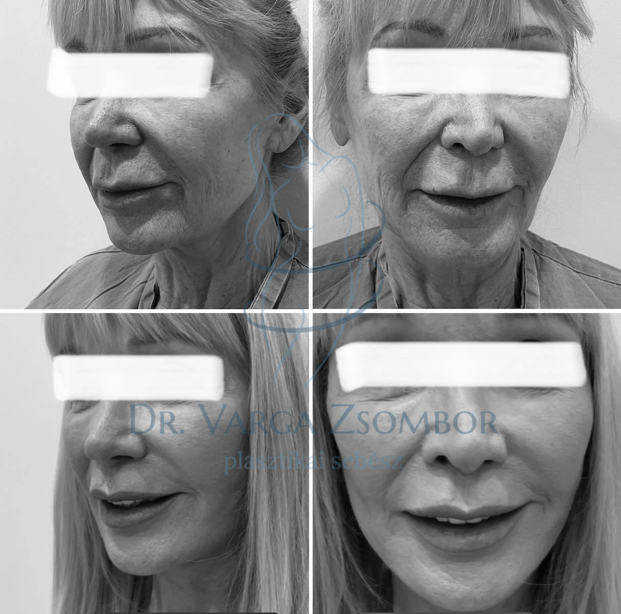Teljes arc- és nyakplasztika műtét ajakemeléssel kiegészítve