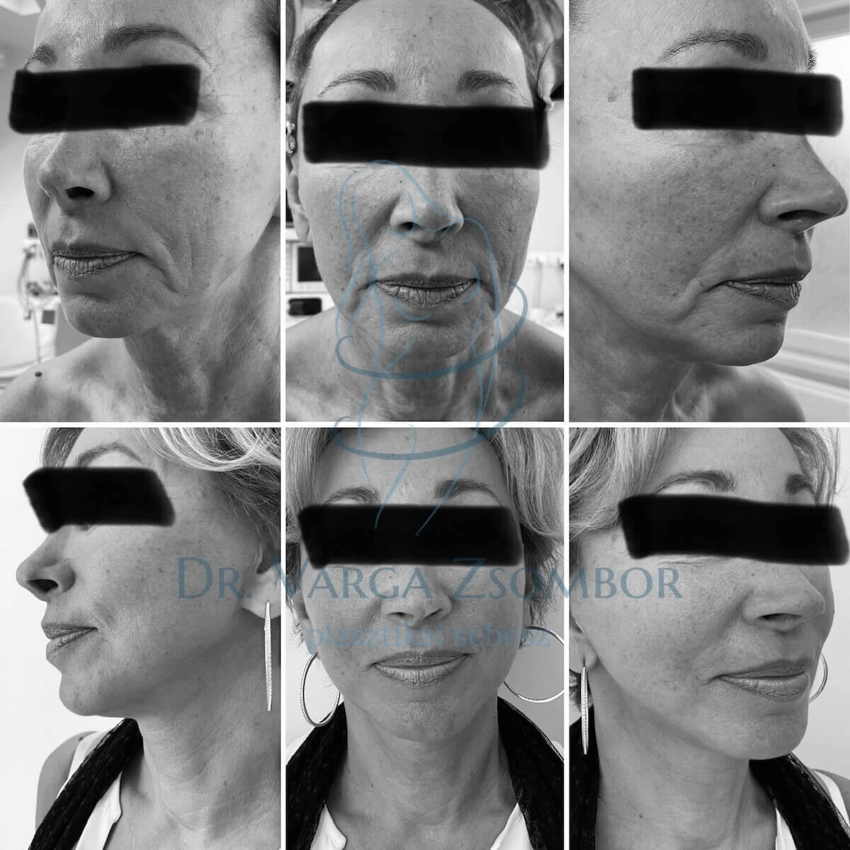 Teljes arc- és nyakplasztika